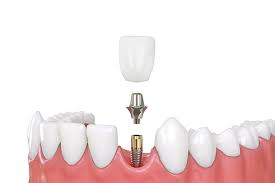 Implants