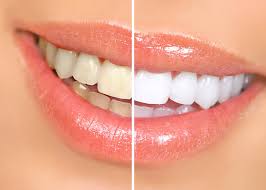 Aligners