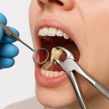 Wisdom Tooth